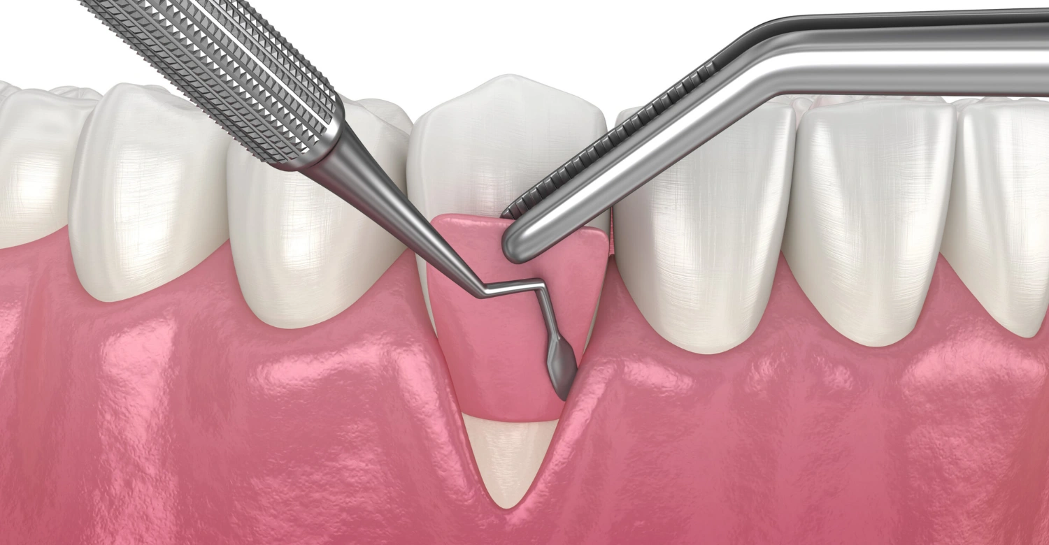 Periodontal Surgery 2